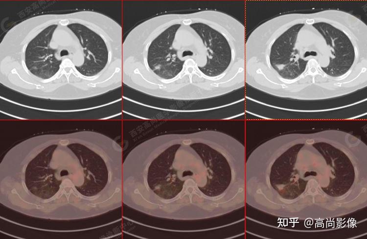 【西安高尚医学影像病例】肺癌pet/ct评效:中晚期肺癌治疗后疗效显著