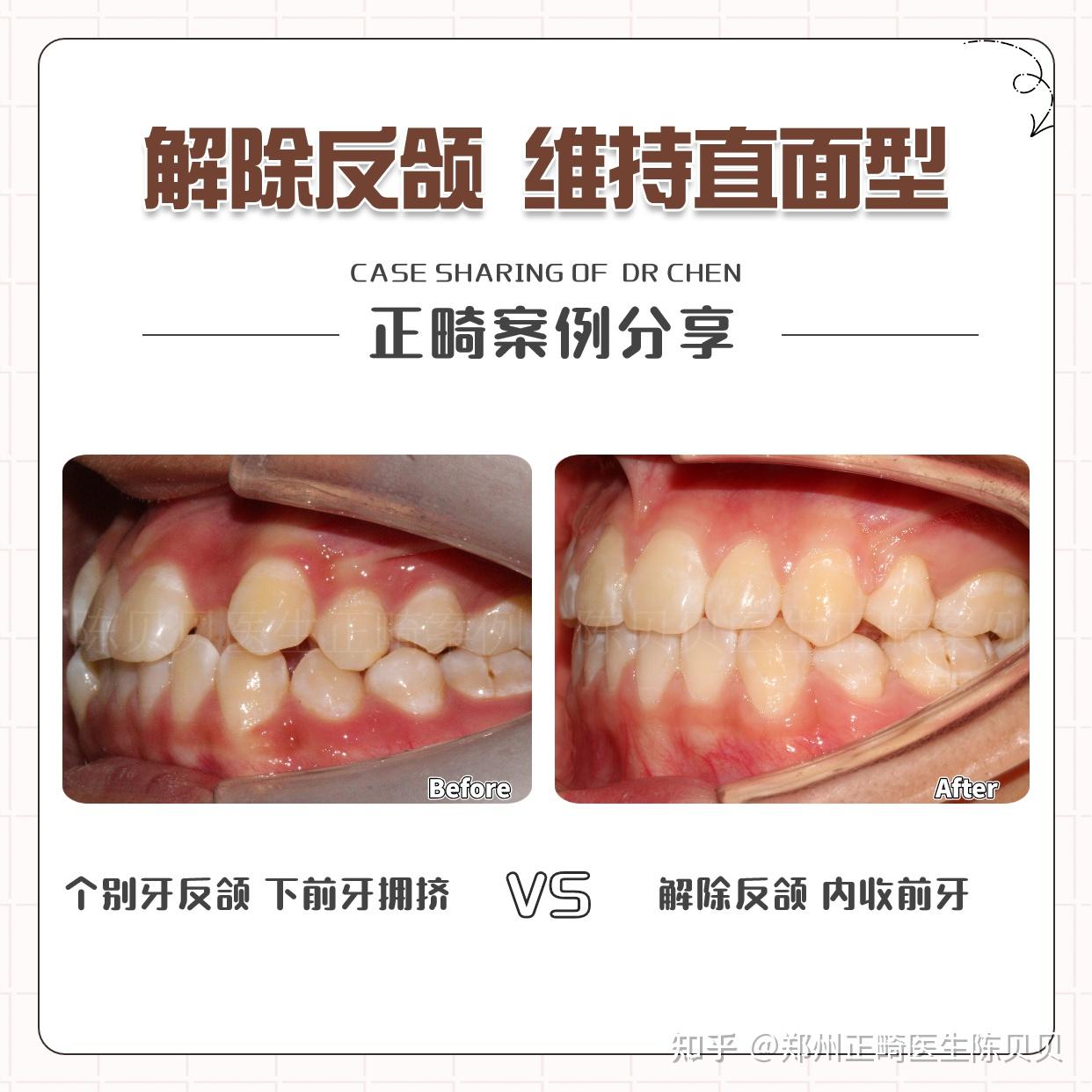 反颌有必要矫正吗?很多父母都后悔太晚看到! - 知乎