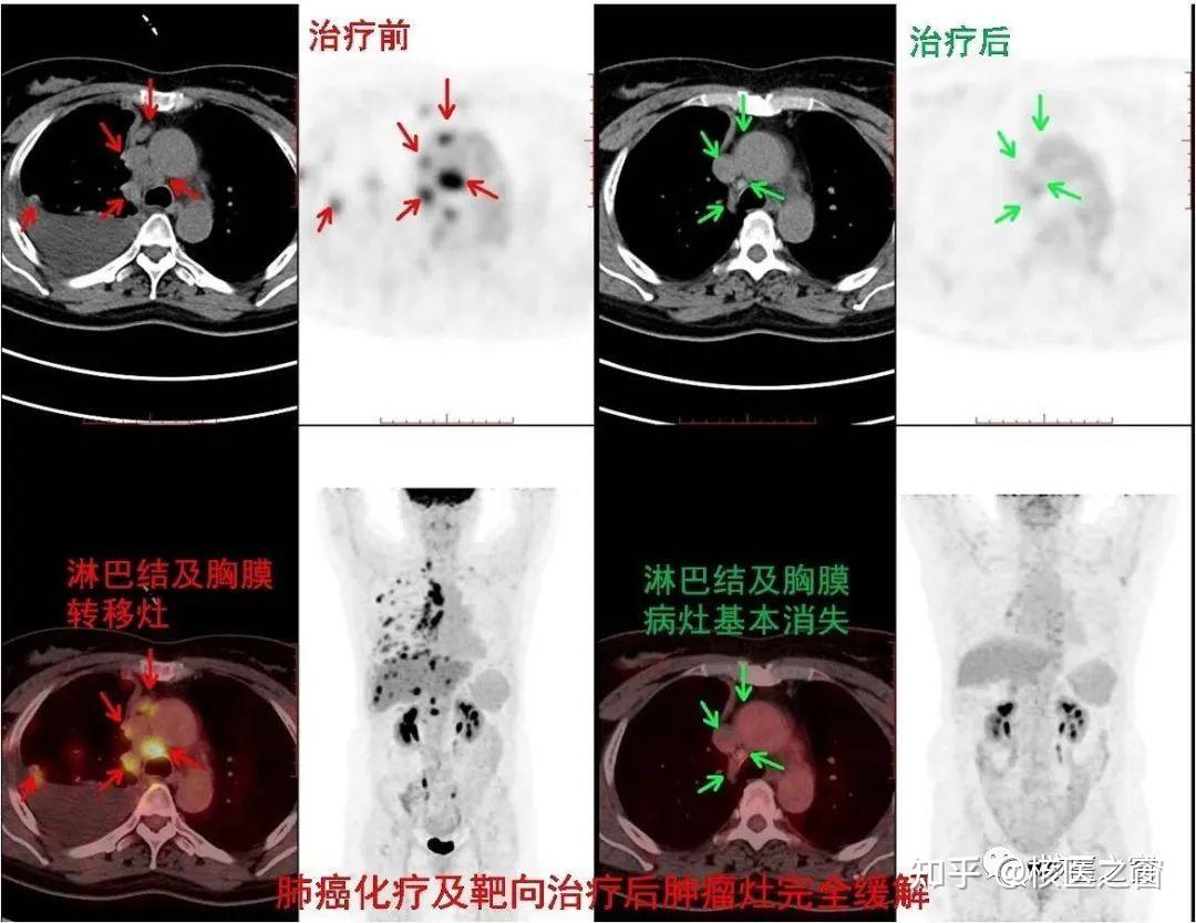 Pet ct 