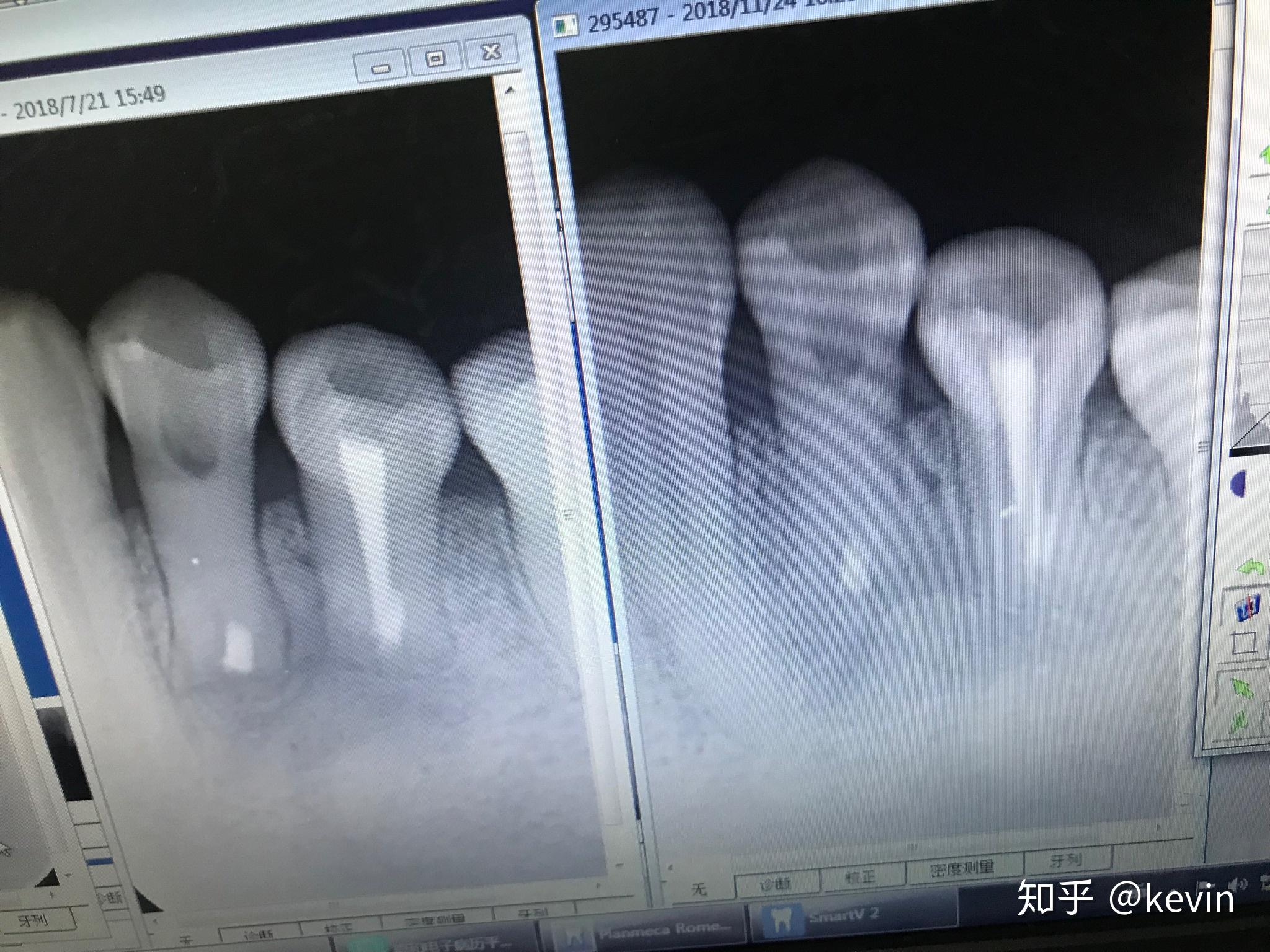 求老师们指点，这个乳牙根尖周炎病例怎么解决比较好-陈广益的博客-KQ88口腔博客