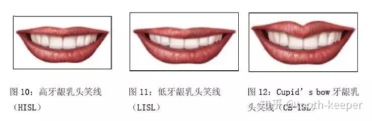 干货分享-笑线分型、分类与美学区种植风险及难度评估 - 知乎