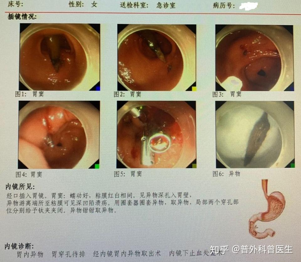 胃穿孔也是外科急症,胃中强酸性的消化液会从穿孔处漏入腹腔,引起严重