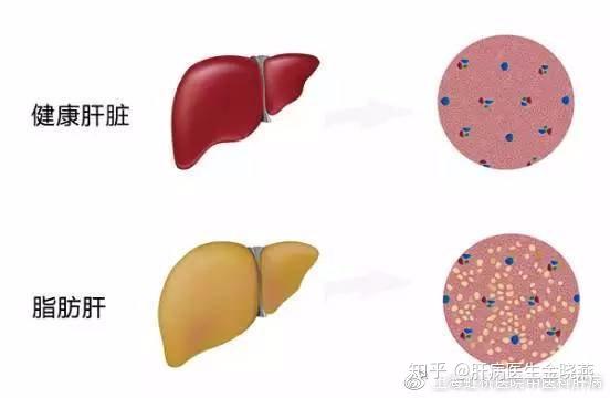 揭秘 脂肪肝有多严重 到底需不需治疗 知乎