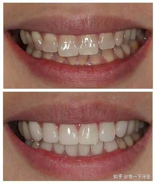 牙齿贴面 - 知乎
