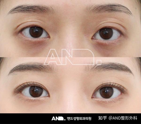 突出眼睛很难做双眼皮手术吗？ [眼部整形（切开双眼皮+切开眼眸矫正+眼部脂肪调整+开内眼角）] - 知乎