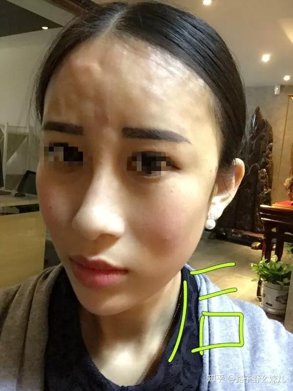 成寿星佬打成苹果肌下垂的脸上僵硬分层的有把脸打成面包的提到玻尿酸