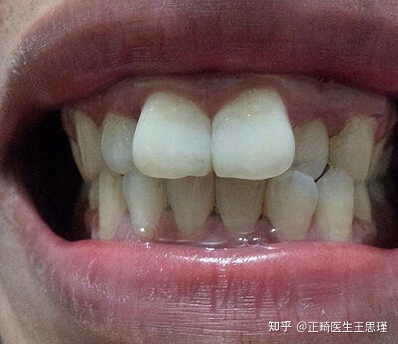 门牙不整齐，磨牙戴牙冠好不好？ - 知乎
