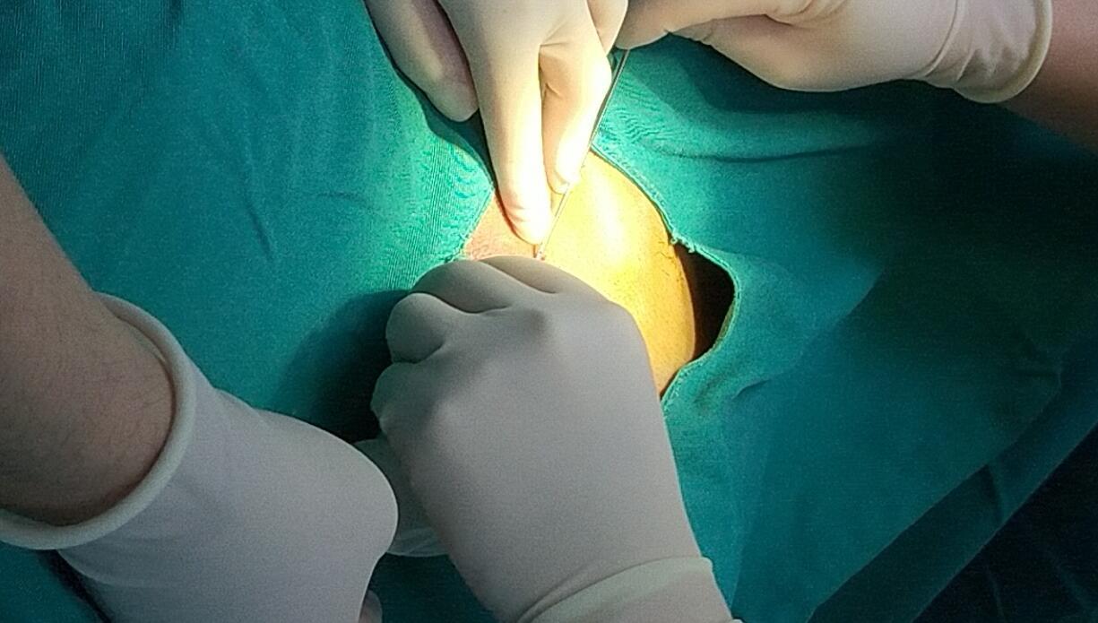 玻尿酸治疗男性早泄的过程