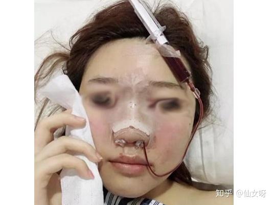 不看后悔肋骨鼻术后第二天来反馈自体肋骨鼻到底有多痛