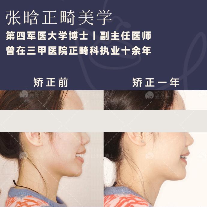 #青岛牙齿矫正:矫正一年缓解嘴突闭唇紧张,下颌逆旋出俏下巴 - 知乎