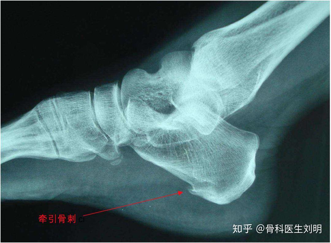 1,跟骨高压症.