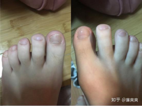 灰指甲怎么治疗用药 v2-68ad8cfa7b2ceb6a5977eac572004959_r.jpg