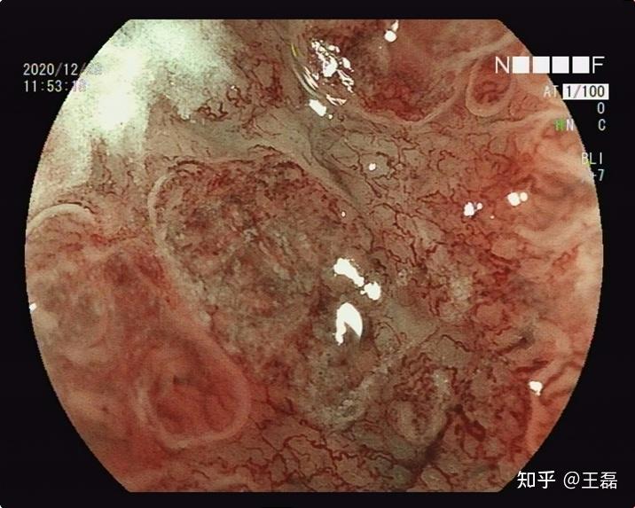 胃镜下贲门癌图片图片