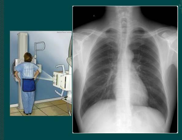 读完此文终于学会看胸片了