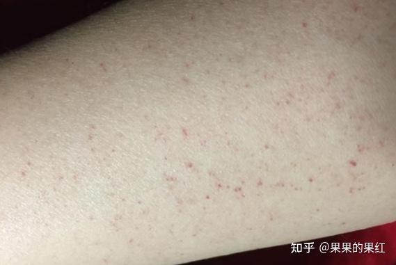 身上突然长了很多小红疹是什么原因？ - 知乎