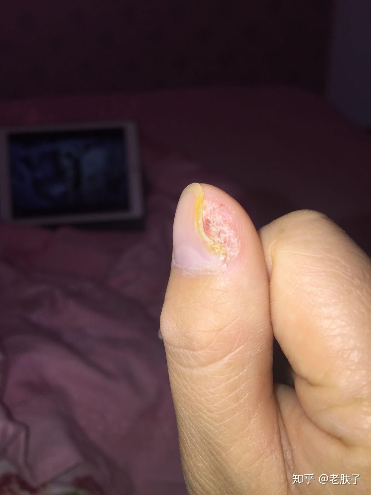 侵蚀了指甲的生长,第二种是甲周疣只是在指甲周边生长,对指甲没有影响