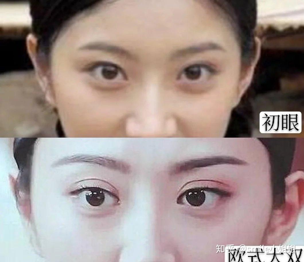 双眼皮误区割的越宽眼睛真的越大吗那你就大错特错了