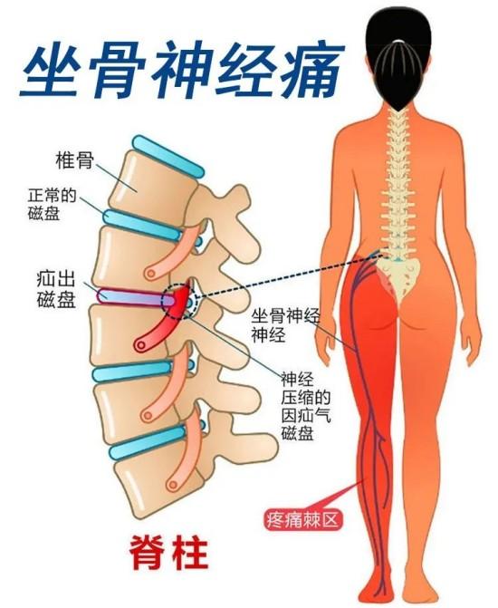 坐骨的准确位置图片图片