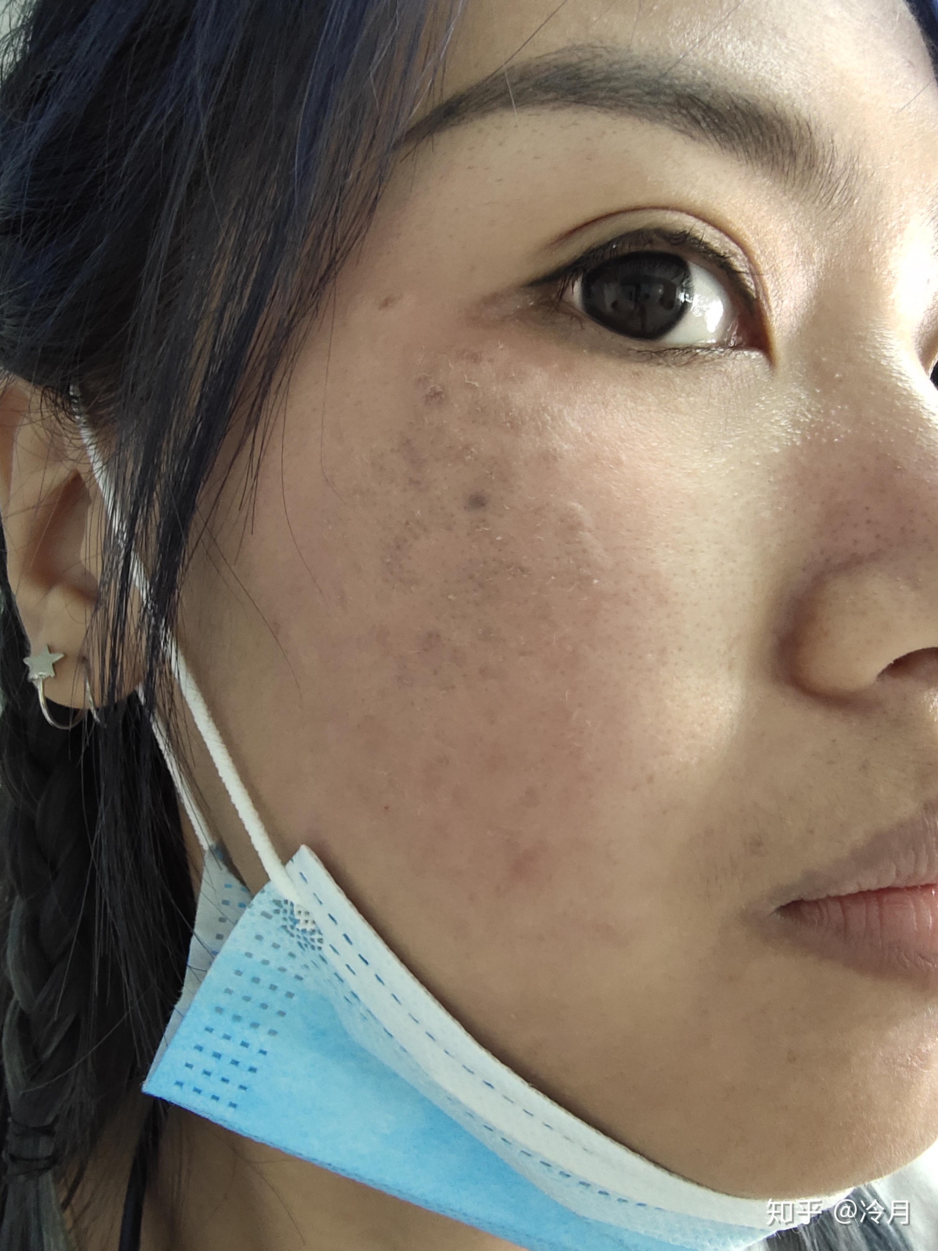 褐青色痣激光日志2