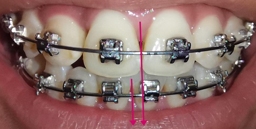 正畸之路 - 知乎