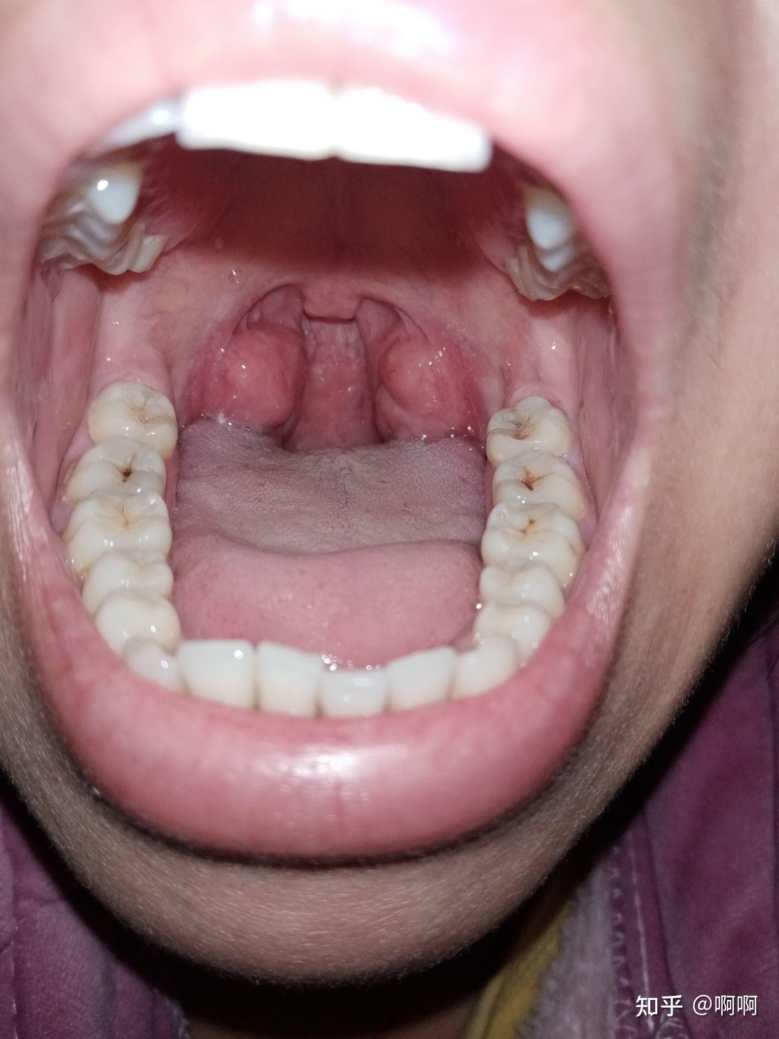 喉咙发炎吞咽口水都疼图片