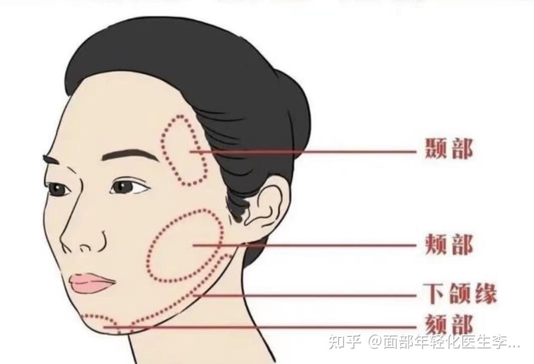 用填充实现面部年轻化需谨记适量 - 知乎