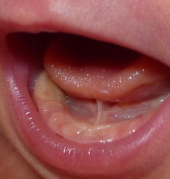嘴里的两条带之舌系带上唇系带过短