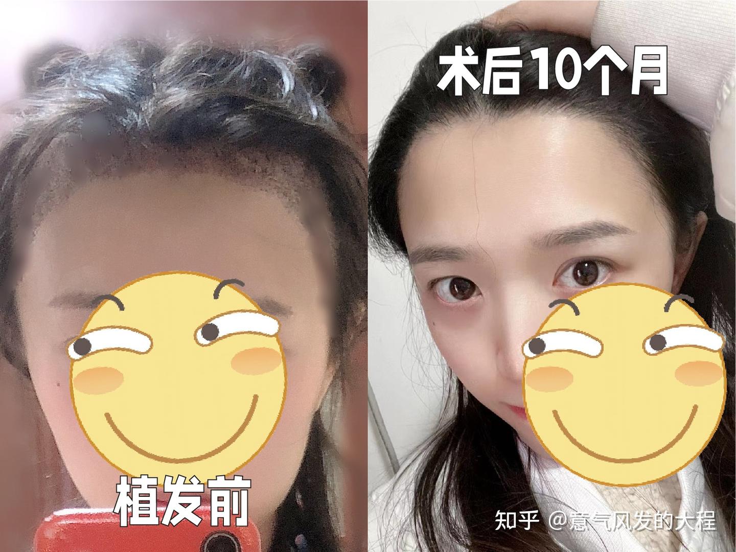 普通人植发应该避开哪些坑?植发到底靠不靠谱? - 知乎