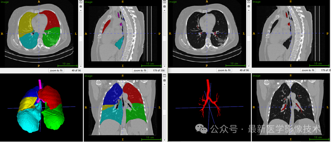 RadGenome-ChestCT2025——视觉-语言对齐胸部CT分析之胸部器官分割 - 知乎