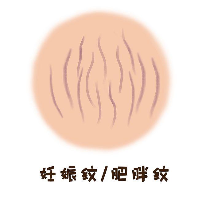 到底什么是妊振纹呢?