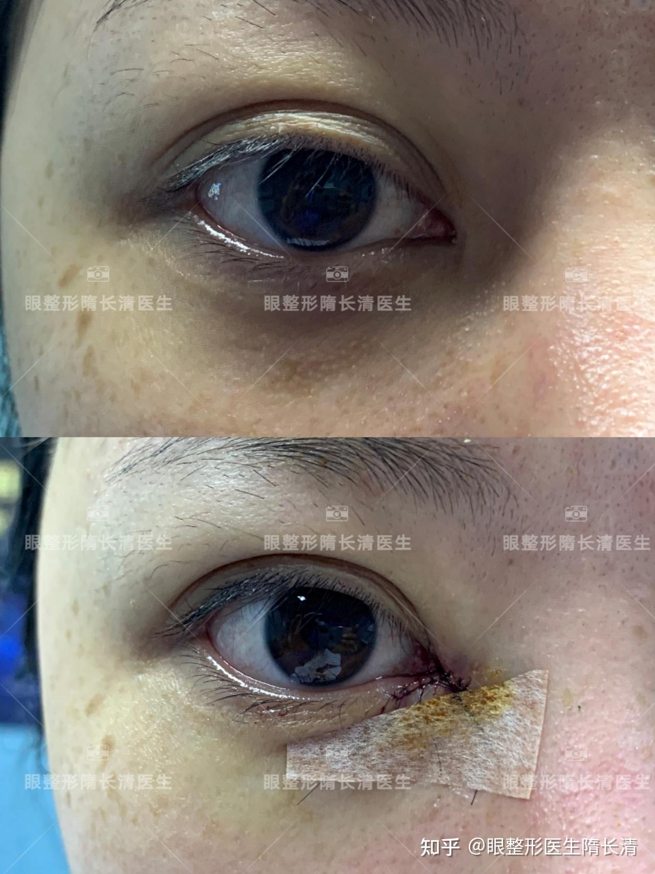 修复内眼角案例分享内眼角修复眼距延长做出彩虹线恢复年轻幼态的感觉