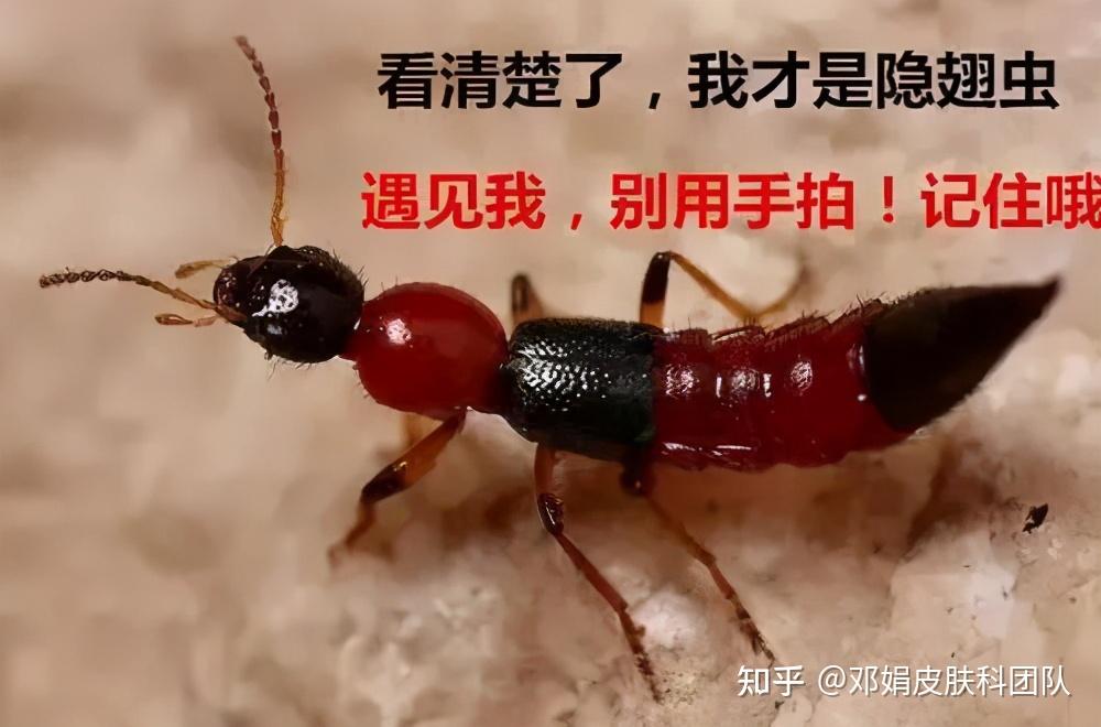 隐翅虫的外观很像蚂蚁,体内却含有强酸性的毒液,一旦直接拍死,体内的