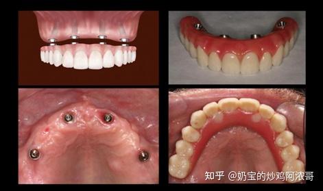 全口种植义齿修复,是一种固定的修复方式,它需要在口内植入数个种植体