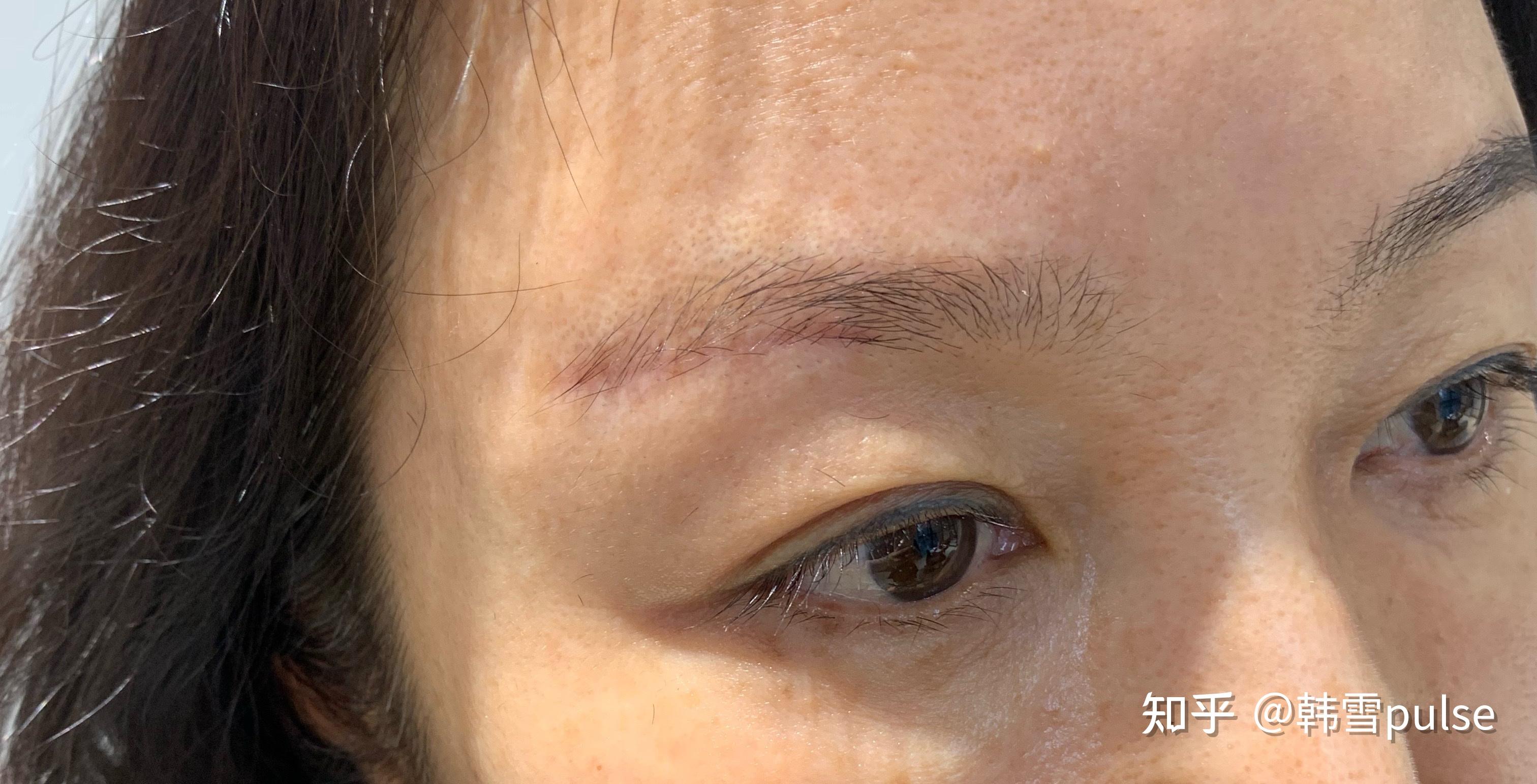 切眉后的疤痕如何通过纹眉改善