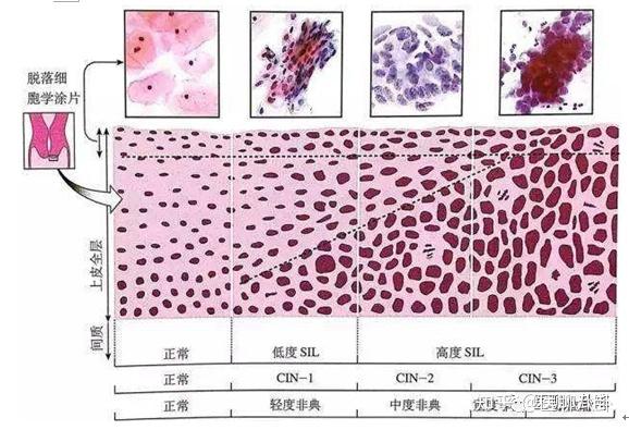 宮頸癌疫苗接種那些你不知道的事重點說hpv感染與癌變問題