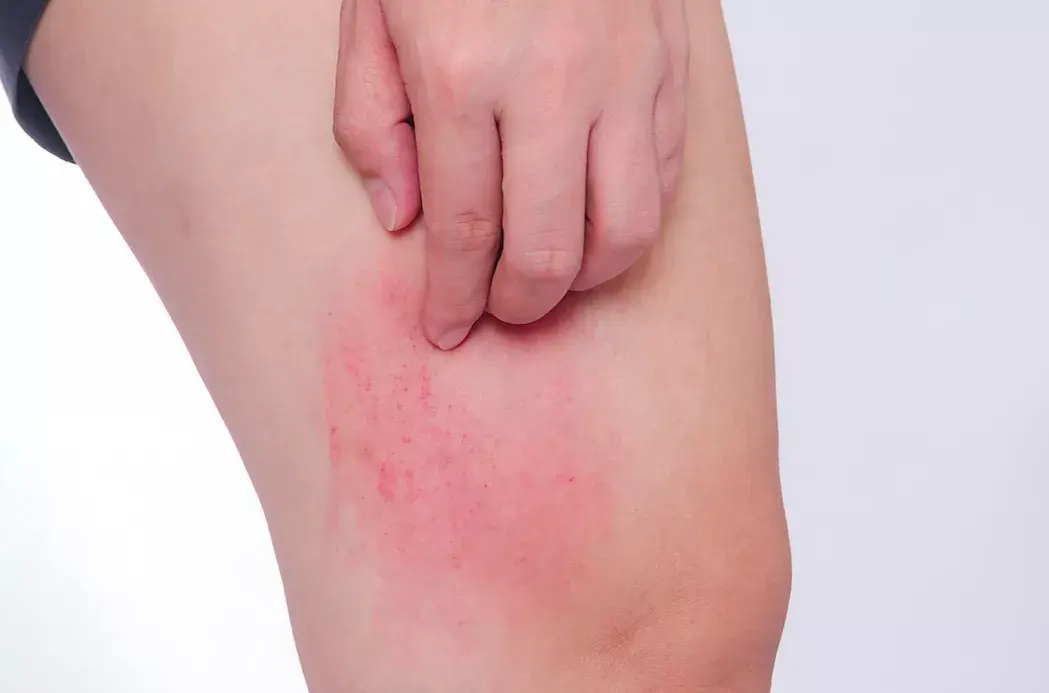 静脉曲张冬季复发,护理3大误区! - 知乎