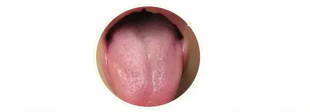 舌头上白色的凸起颗粒图片