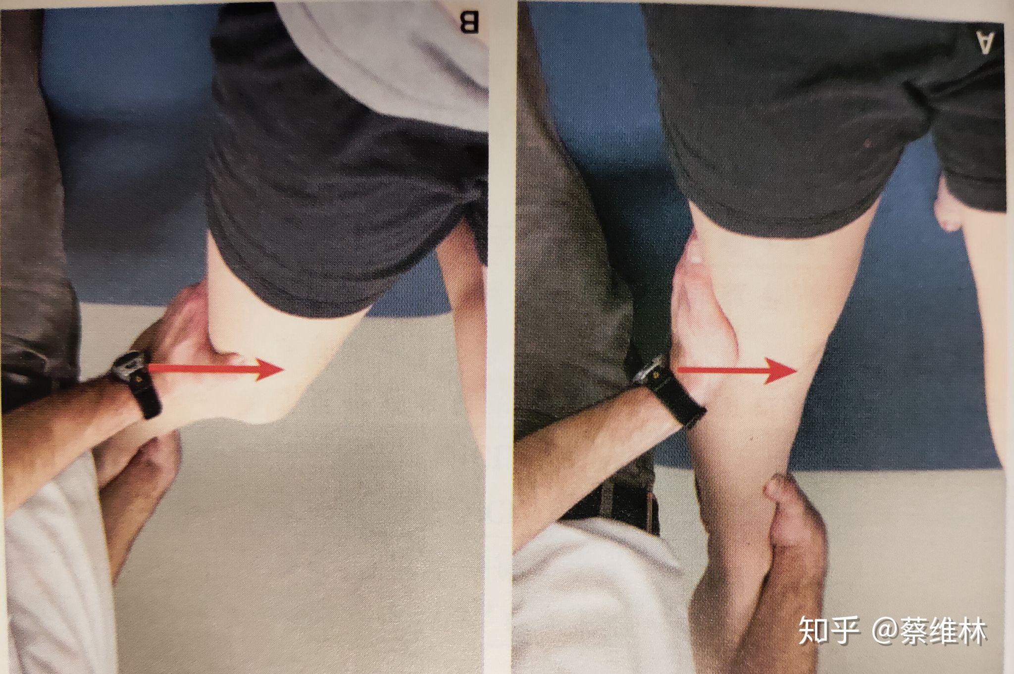 膝关节内翻应力试验图片