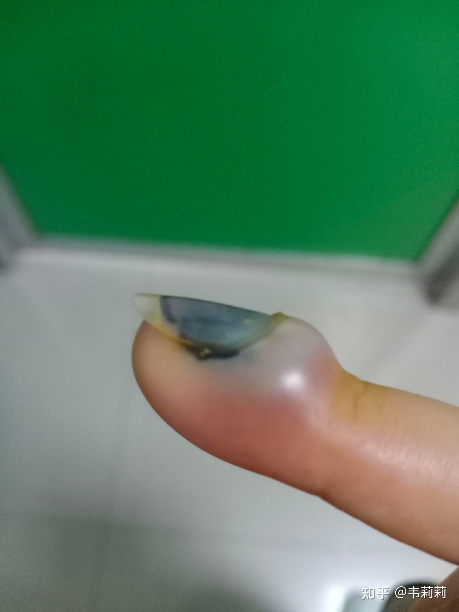 手指甲不小心被砸到发黑发肿该怎么处理