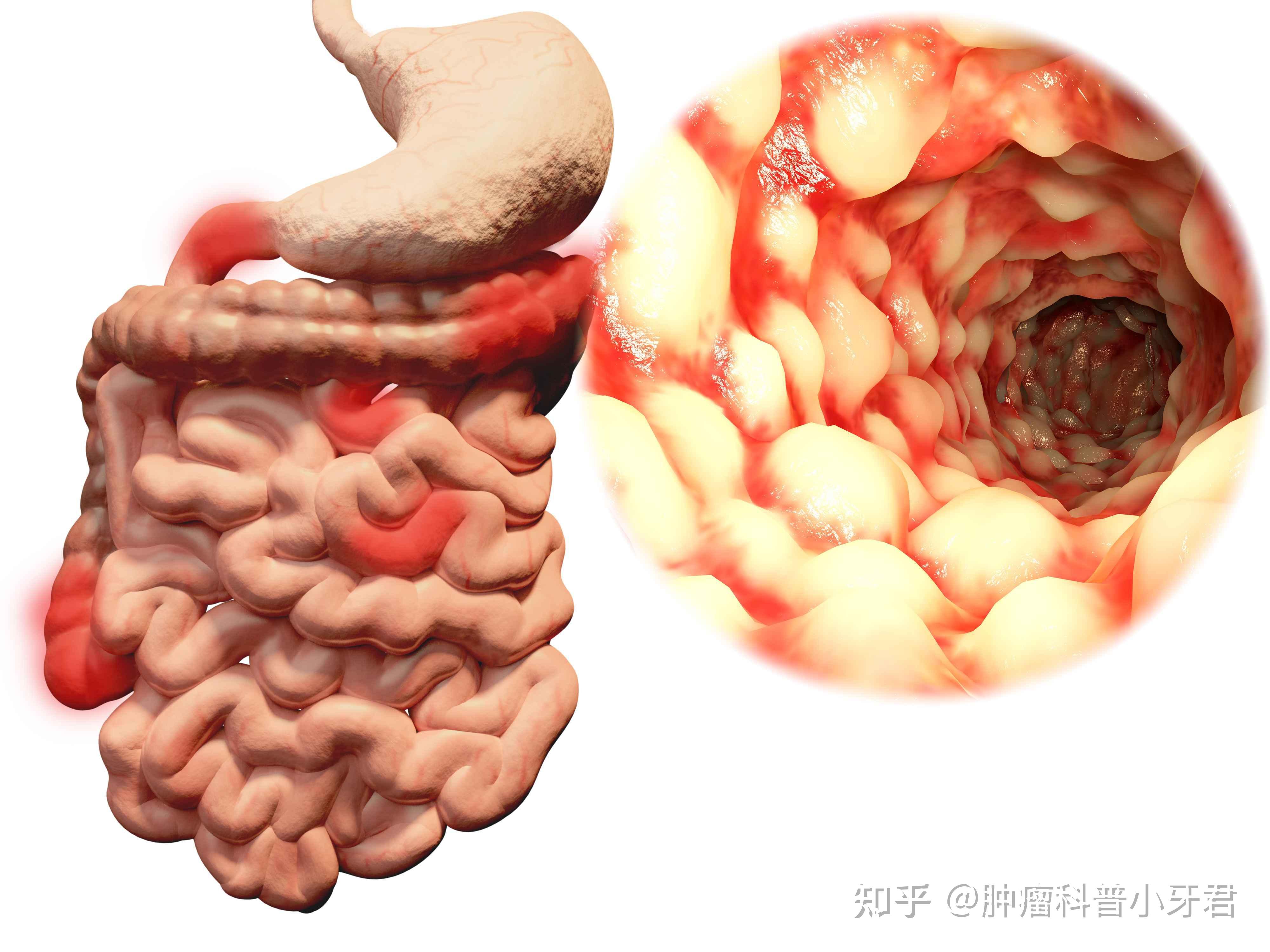 普志東超9成大腸癌源於息肉癌變