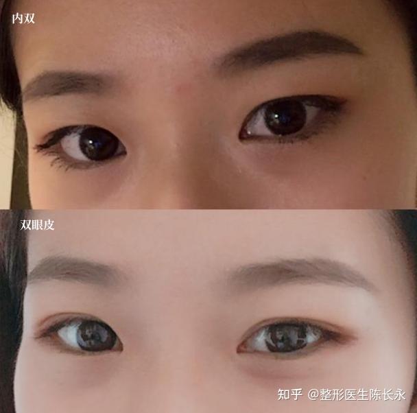 如何辨别自己是内双眼皮,怎么做才能变成双眼皮 - 知乎