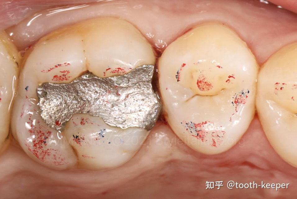 重建牙体原始解剖结构-二类洞直接修复一例