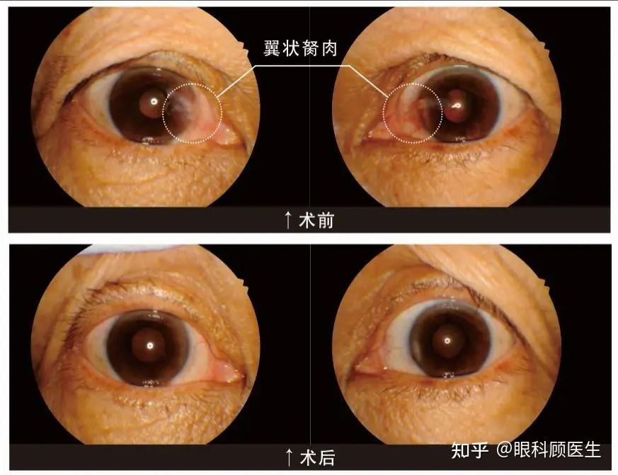 眼睛里的息肉到底是什么