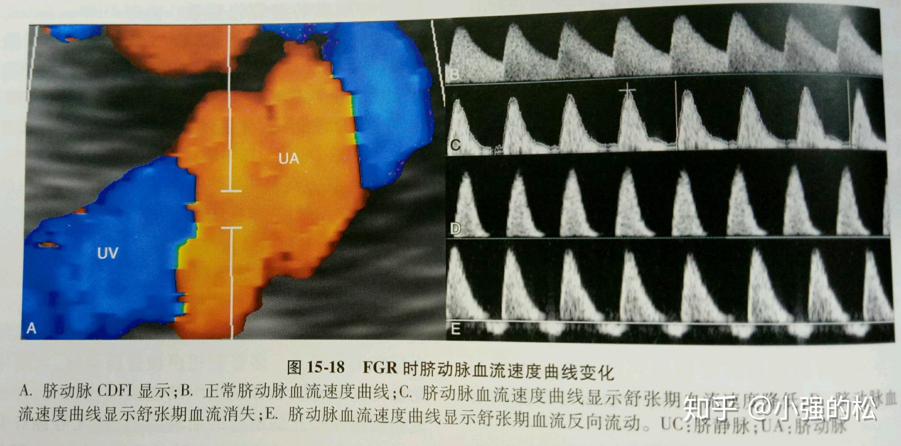 脐动脉s/d体现了在心动周期中血流速度变化的振幅,特别是心脏舒张期
