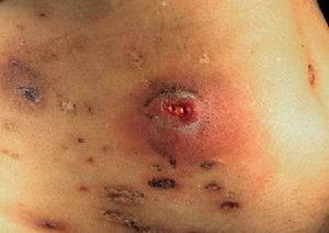 疖痈的形成原因和治疗方法 - 知乎