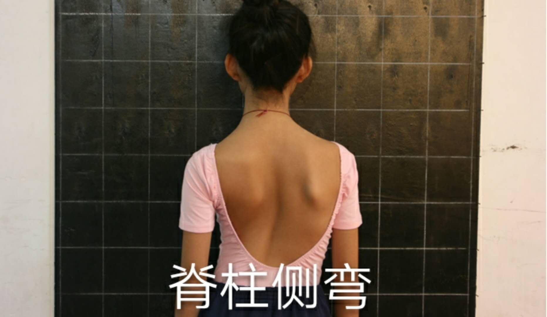 郑州哪里调理脊柱侧弯比较好