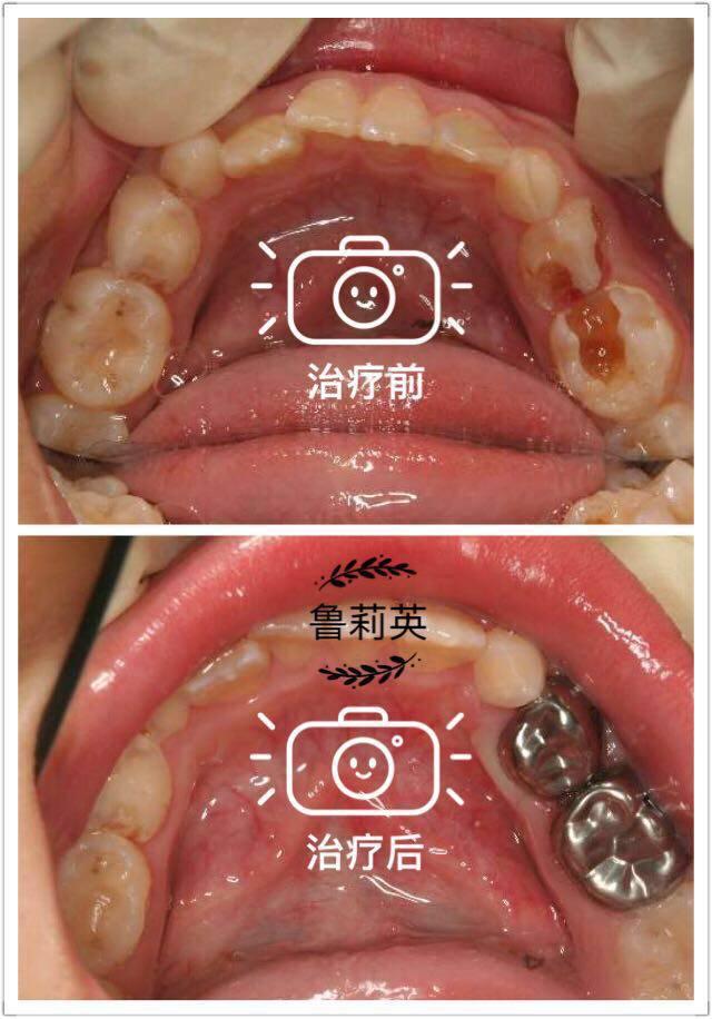 妈妈们乳牙补牙材料知多少
