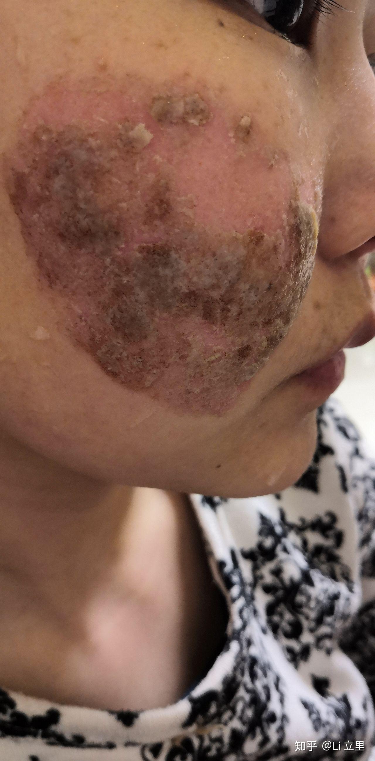 co2二氧化碳点阵激光术后