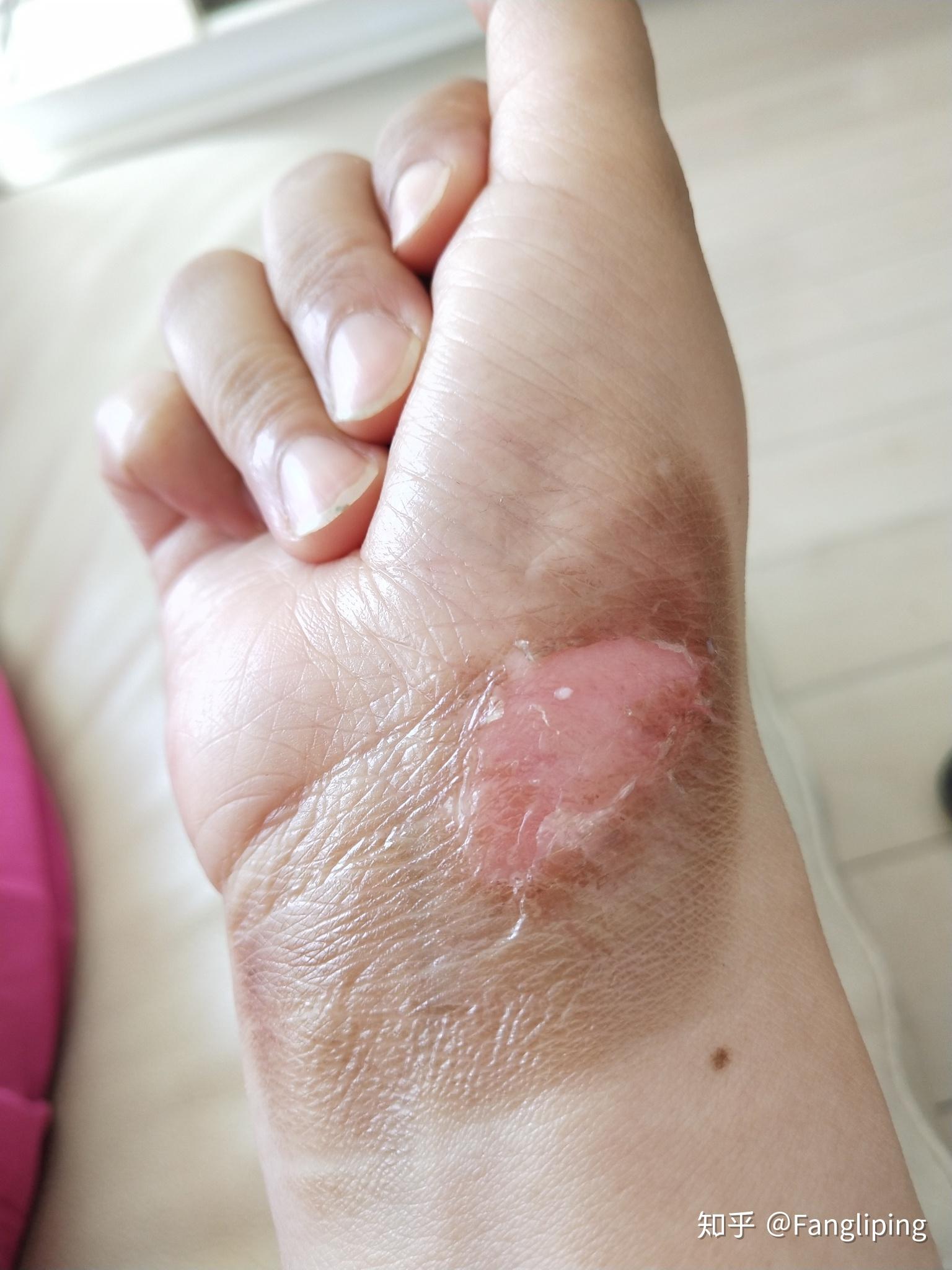 烫伤记录 - 知乎