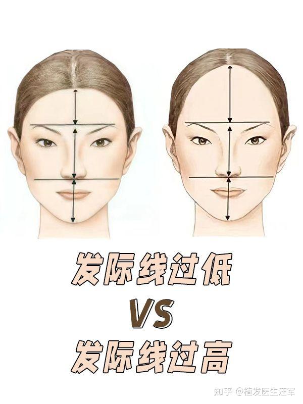 发际线美学分析:如何确定最适合自己的发际线高度和形态? - 知乎